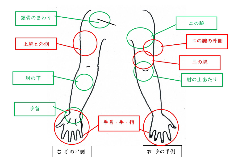 腕 の 痛み 更年期