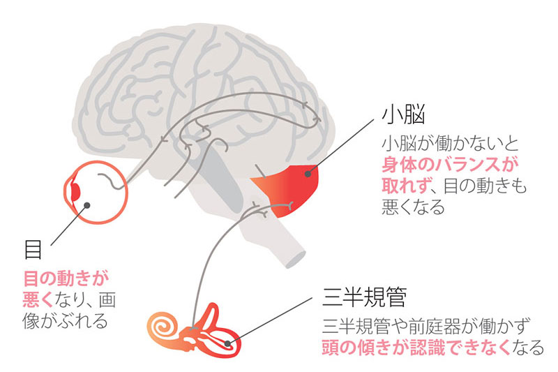 原因①:耳の中の三半規管・前庭器が弱くなっている