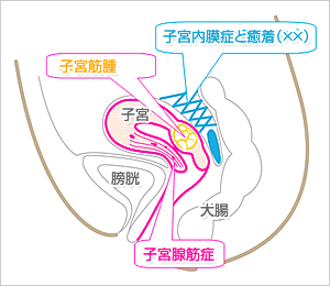 子宮筋腫・内膜症・腺筋症とは？