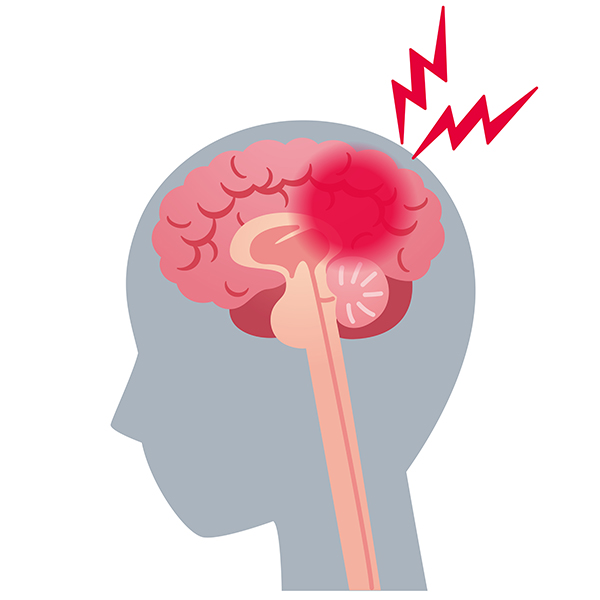 一般的に言われる片頭痛の原因とは