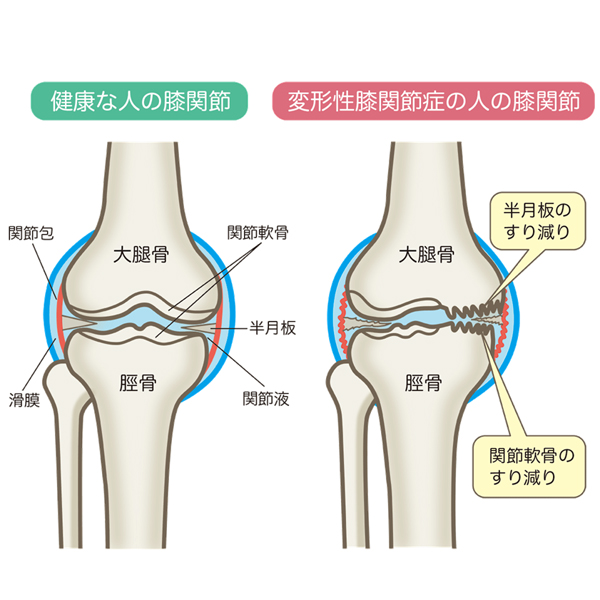 一般的に言われる頭痛の原因とは