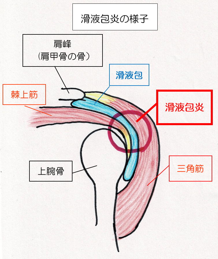 一般的に言われる四十肩・五十肩の原因とは